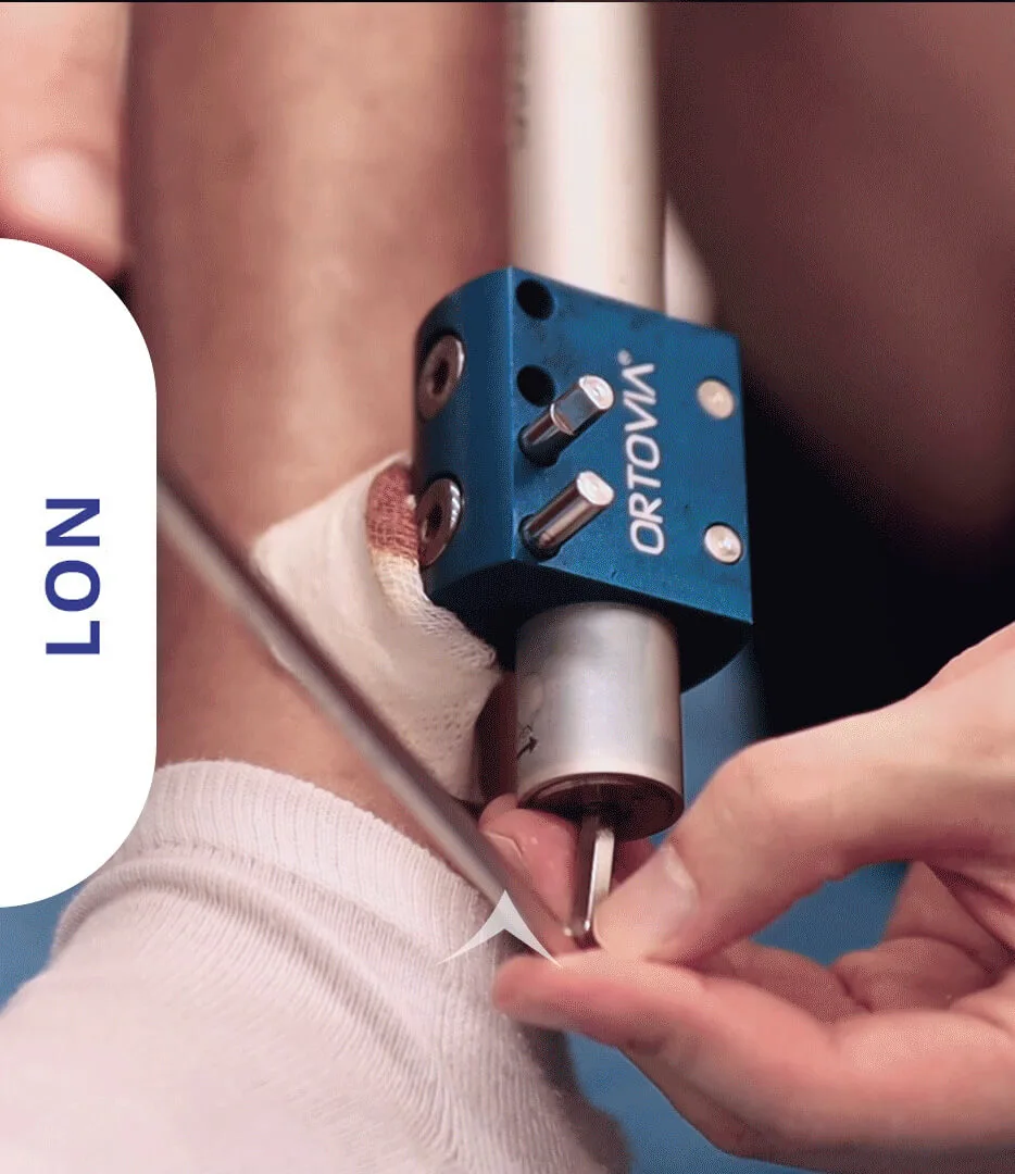 Méthode LON utilisée pour la chirurgie d’allongement des jambes